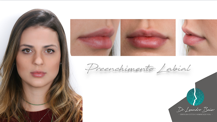 Verdades e Mitos o Preenchimento Labial