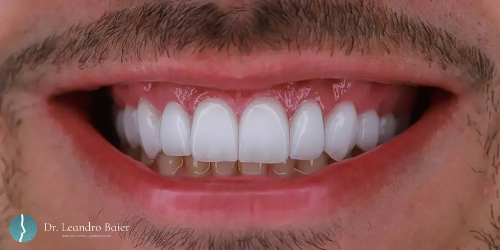 Lentes de Contato Dental: Muito Mais do que Estética!