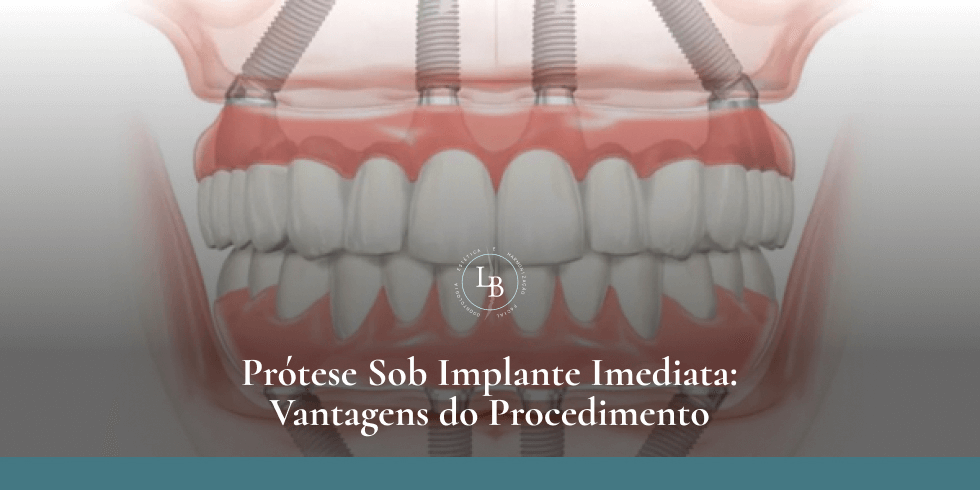 Prótese Sob Implante Imediata: Vantagens do Procedimento